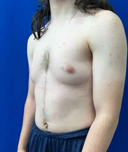 FTM Keyhole Minimally Invasive case #15555