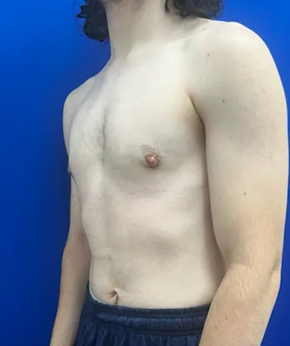 FTM Keyhole Minimally Invasive case #15555