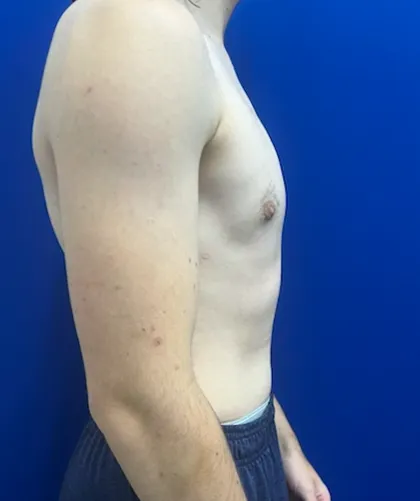 FTM Keyhole Minimally Invasive case #15555