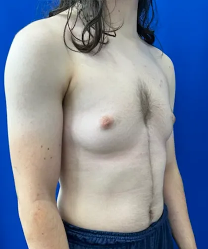 FTM Keyhole Minimally Invasive case #15555