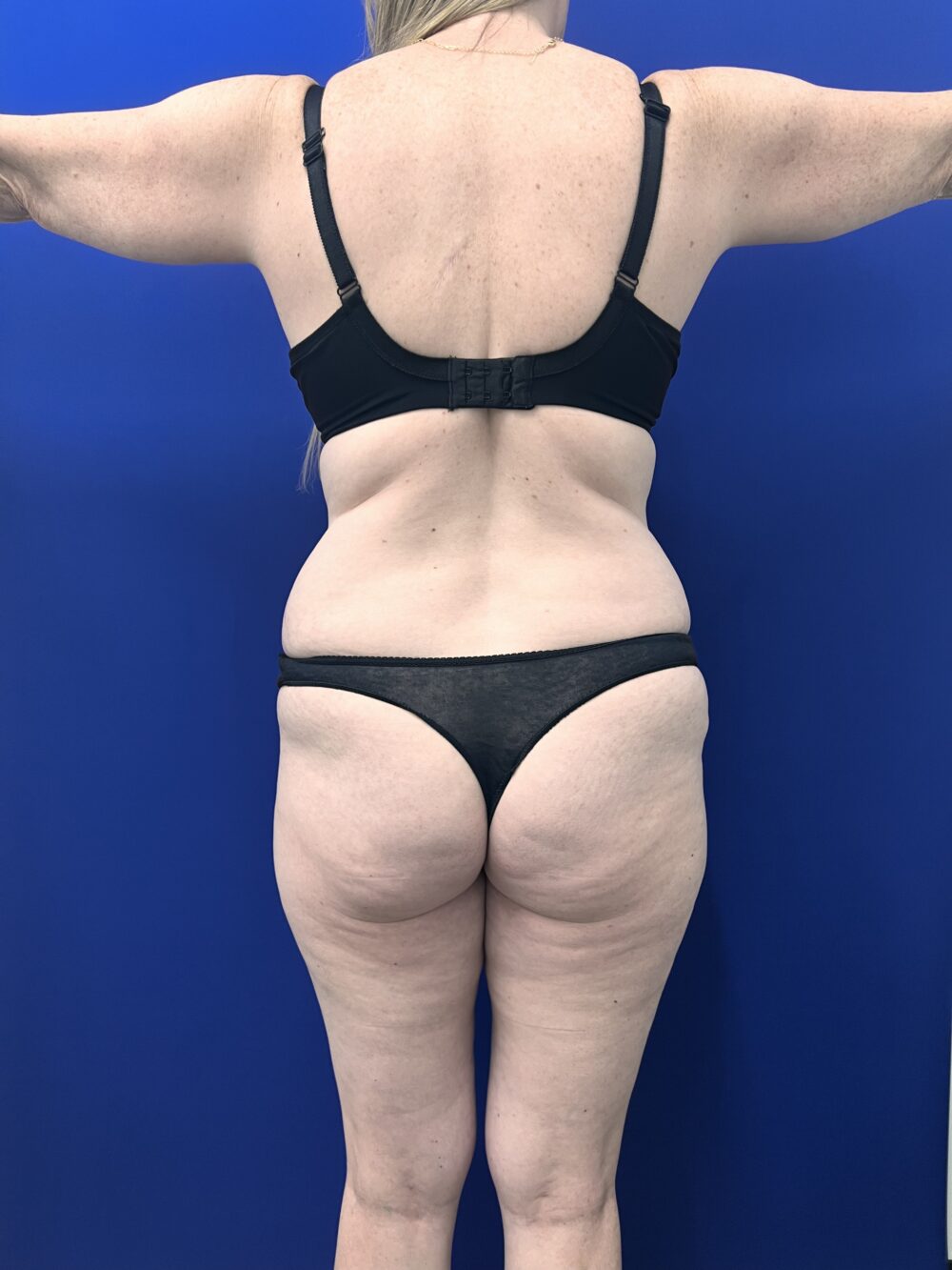 Brazilian Butt Lift case #15989