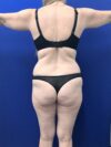 Brazilian Butt Lift case #15989