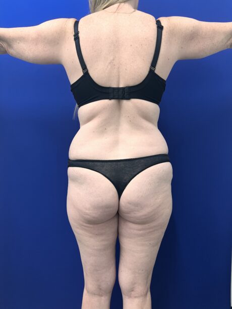 Brazilian Butt Lift case #15989