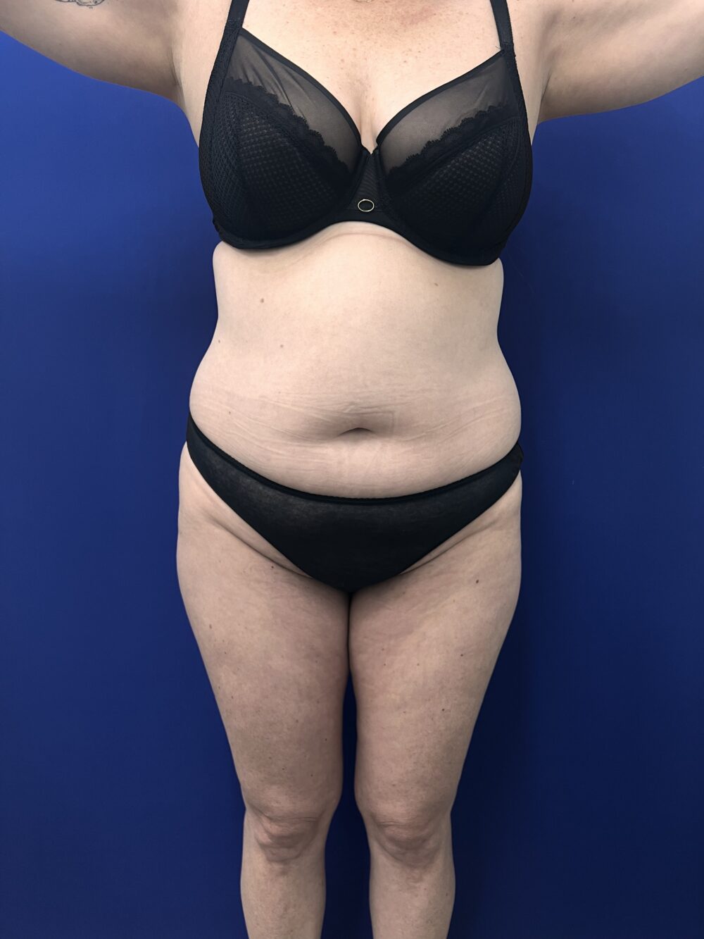 Brazilian Butt Lift case #15989