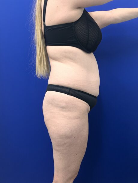 Brazilian Butt Lift case #15989