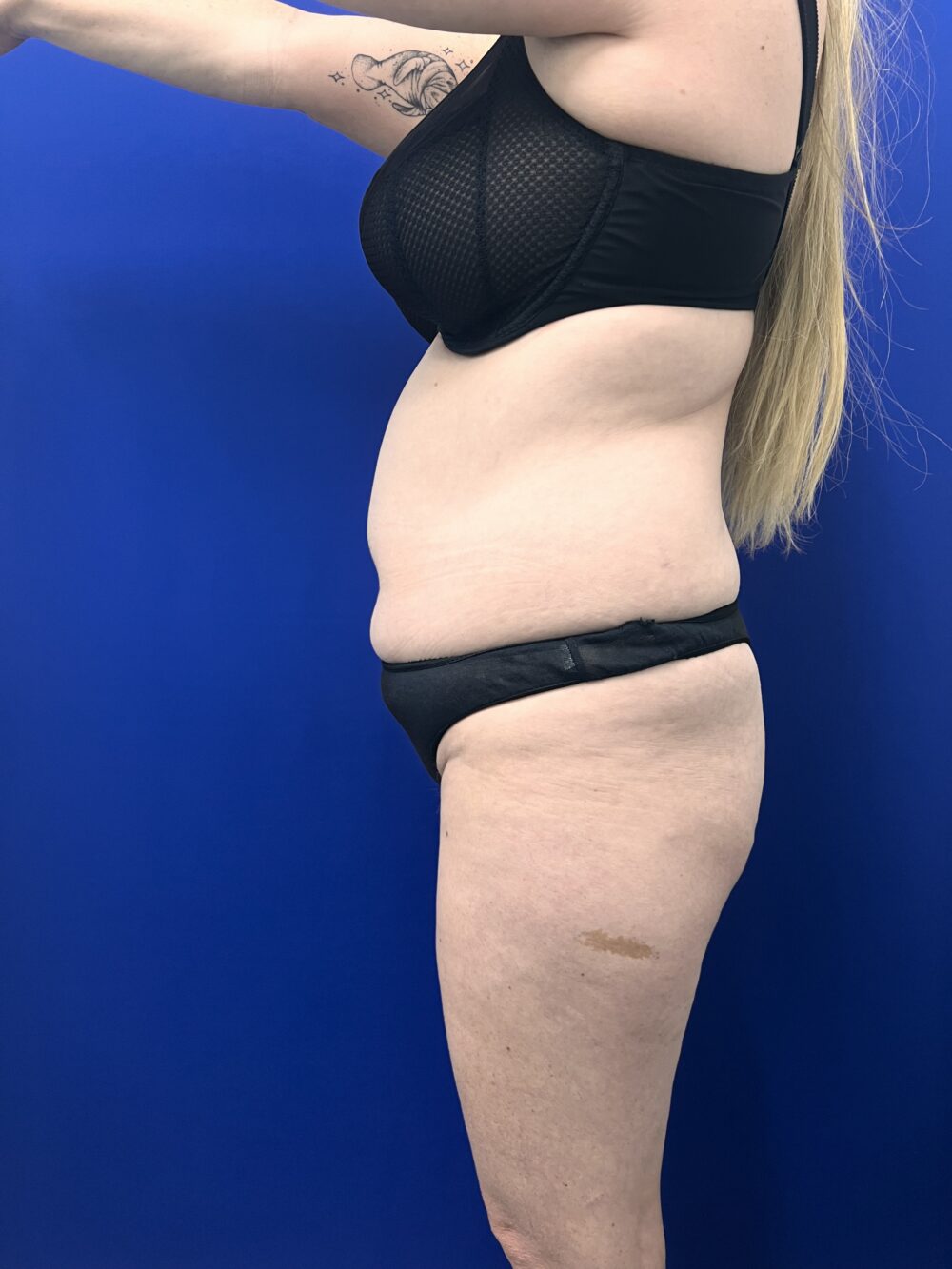 Brazilian Butt Lift case #15989