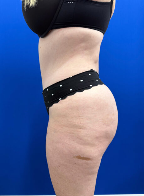 Brazilian Butt Lift case #15989