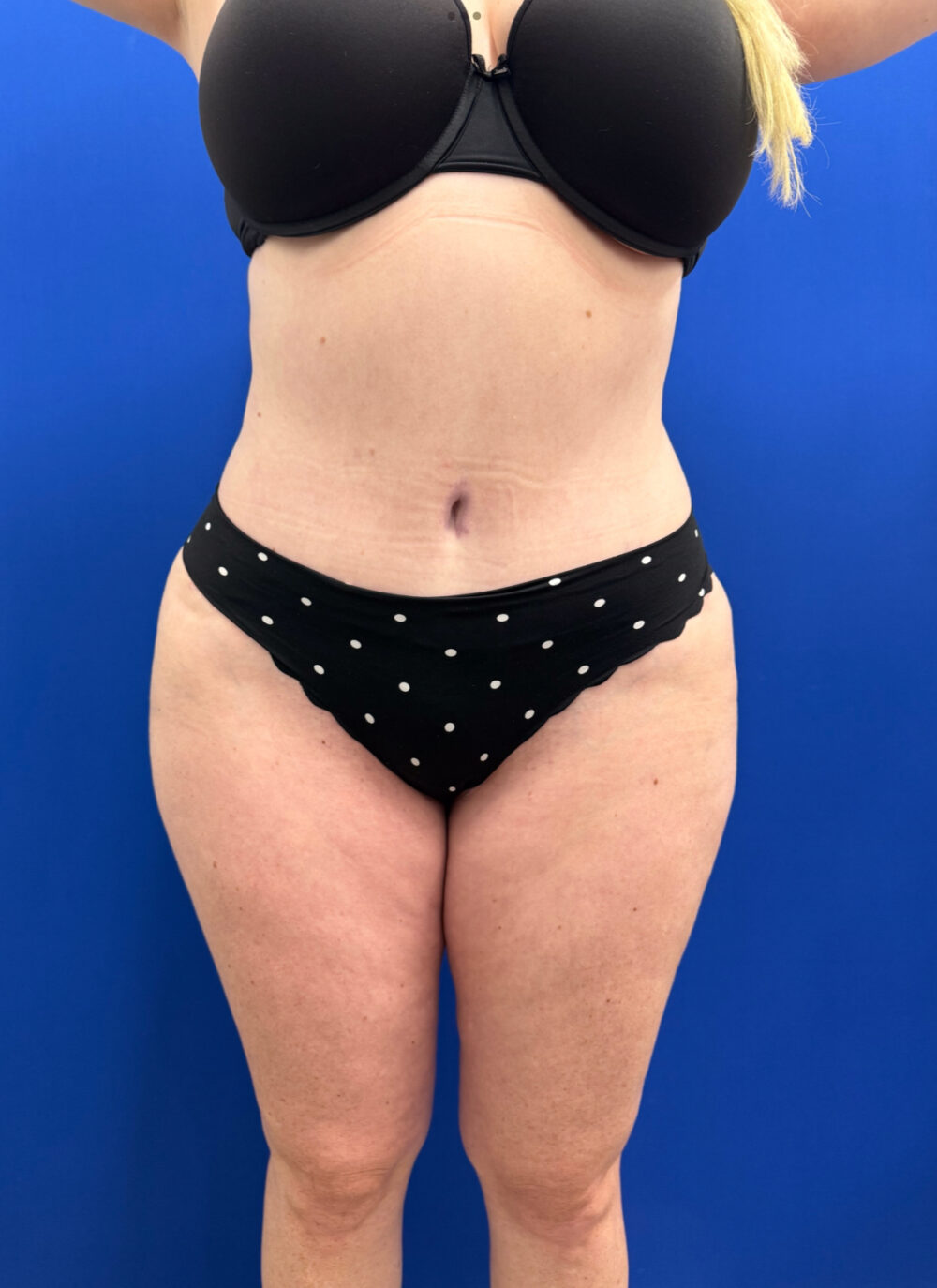 Brazilian Butt Lift case #15989