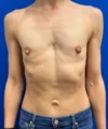 Tranaxillary  Breast Augmentation case #16032