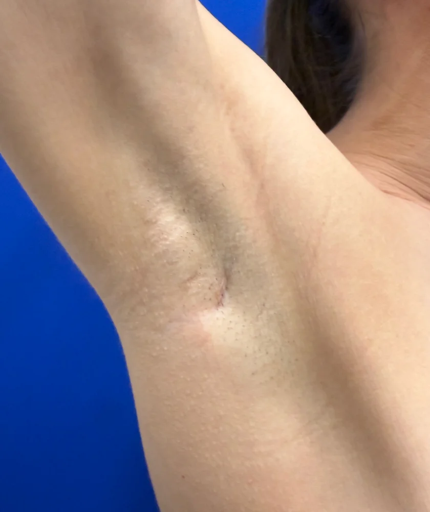 Tranaxillary  Breast Augmentation case #16032