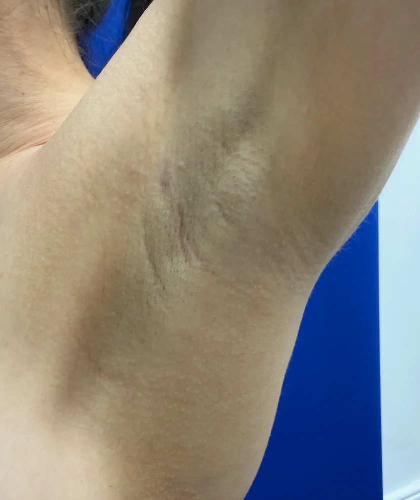 Tranaxillary  Breast Augmentation case #16032