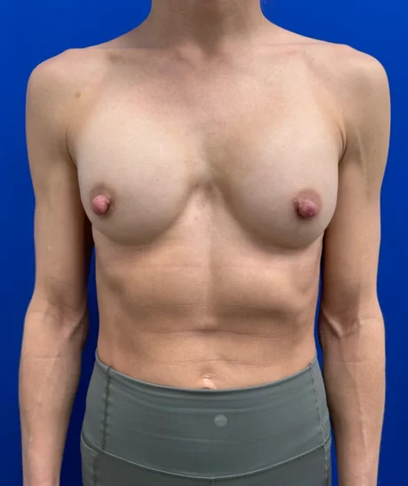 Tranaxillary  Breast Augmentation case #16032