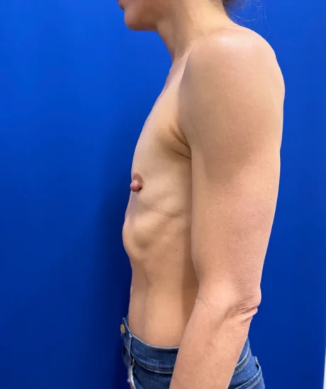 Tranaxillary  Breast Augmentation case #16032