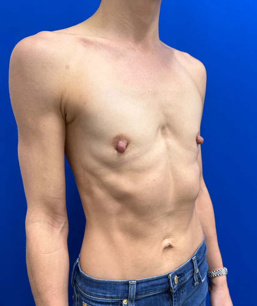 Tranaxillary  Breast Augmentation case #16032