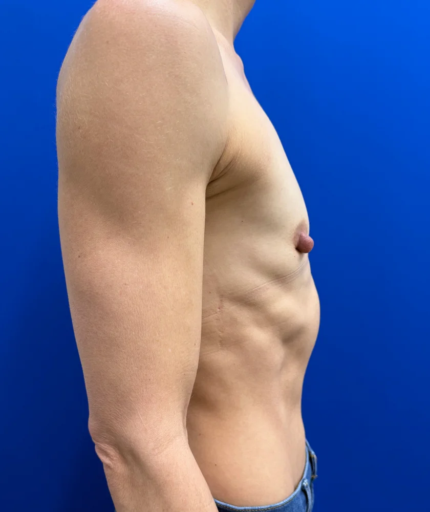 Tranaxillary  Breast Augmentation case #16032