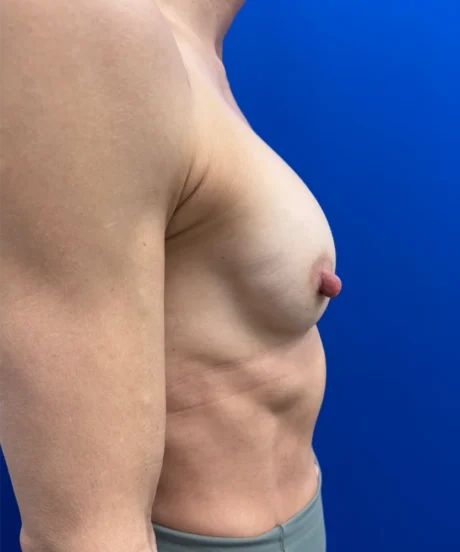 Tranaxillary  Breast Augmentation case #16032