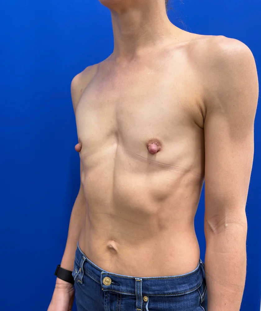 Tranaxillary  Breast Augmentation case #16032