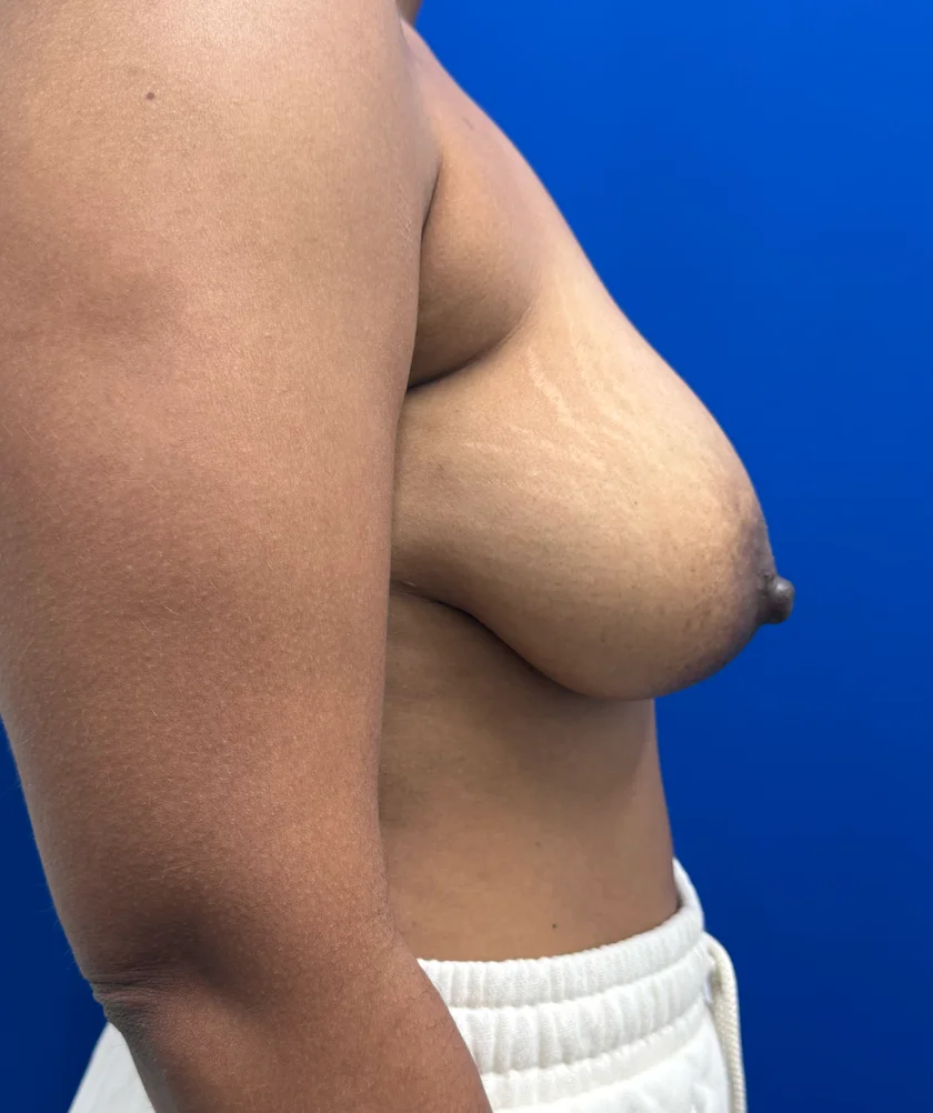 Breast Implants and Lift case #16145