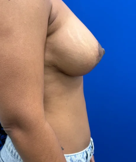 Breast Implants and Lift case #16145