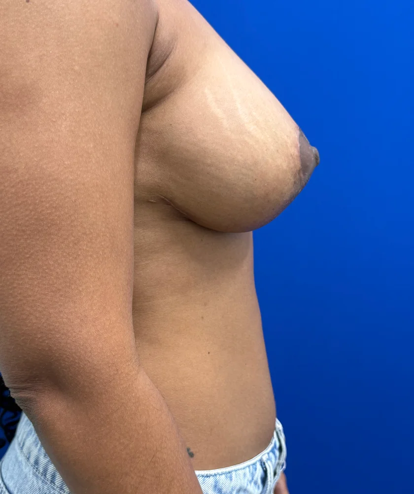 Breast Implants and Lift case #16145