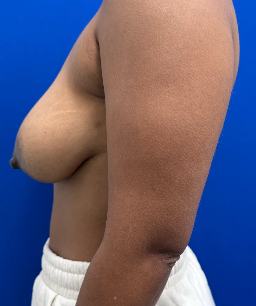 Breast Implants and Lift case #16145
