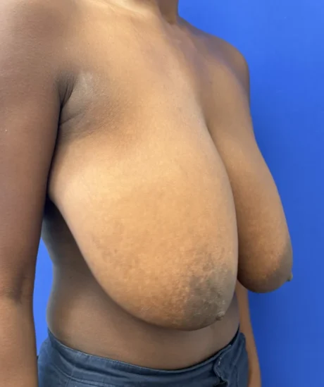Breast Reduction case #16134