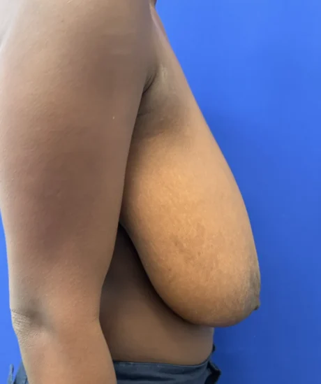 Breast Reduction case #16134