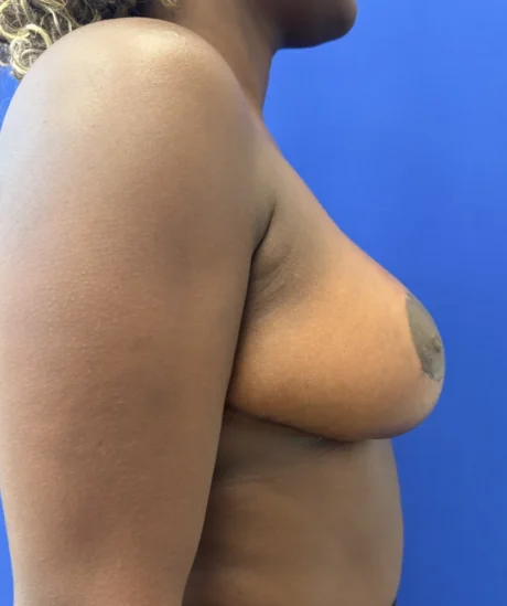 Breast Reduction case #16134