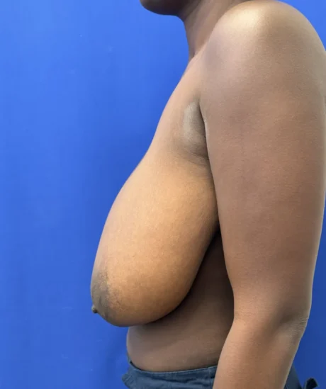 Breast Reduction case #16134