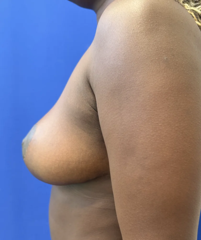 Breast Reduction case #16134