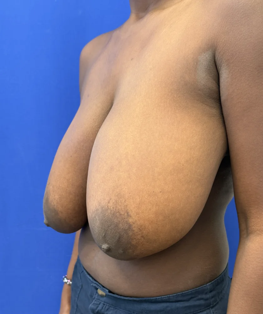 Breast Reduction case #16134