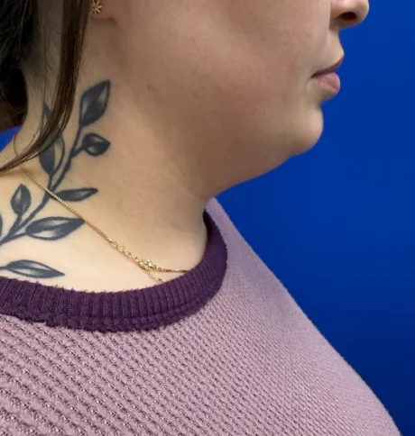 Neck Liposuction case #16121