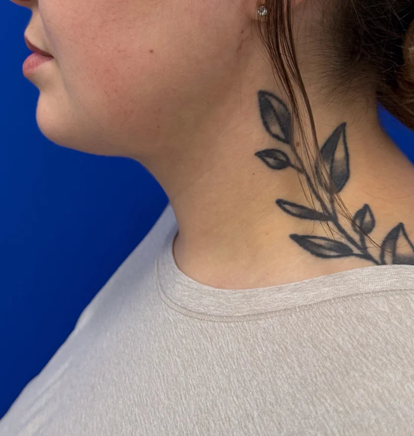 Neck Liposuction case #16121