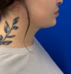 Neck Liposuction case #16121