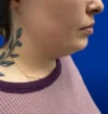Neck Liposuction case #16121