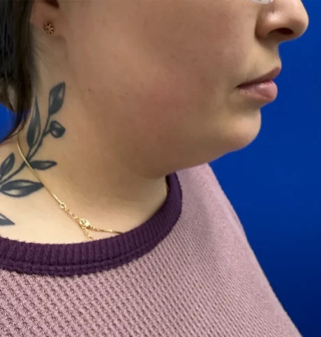 Neck Liposuction case #16121