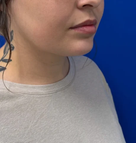 Neck Liposuction case #16121