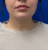 Neck Liposuction case #16121