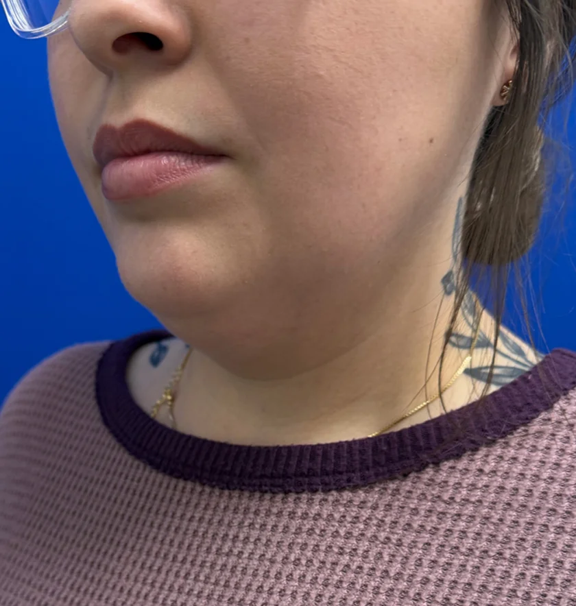 Neck Liposuction case #16121