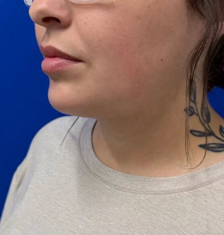 Neck Liposuction case #16121