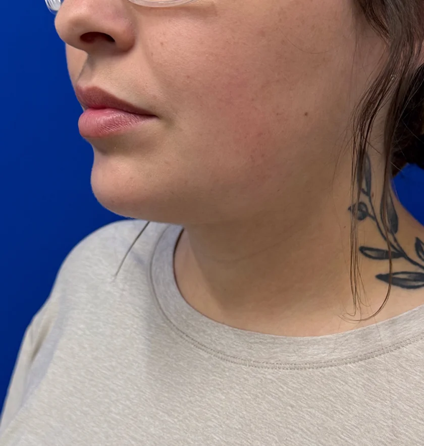 Neck Liposuction case #16121