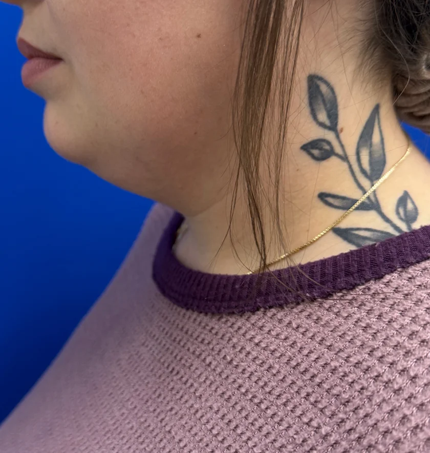 Neck Liposuction case #16121
