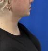 Neck Liposuction case #16096