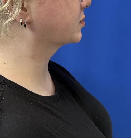 Neck Liposuction case #16096