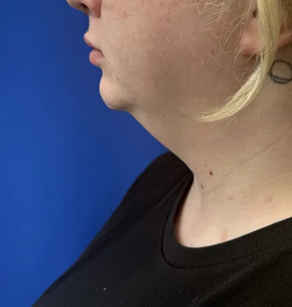Neck Liposuction case #16096
