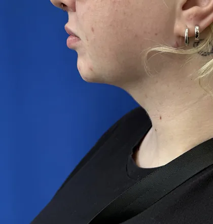 Neck Liposuction case #16096