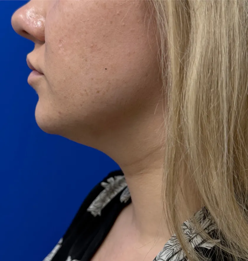 Neck Liposuction case #16426