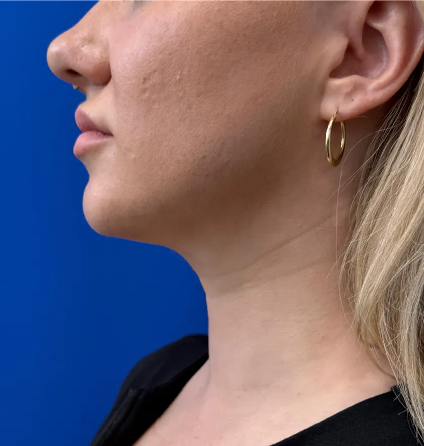 Neck Liposuction case #16426
