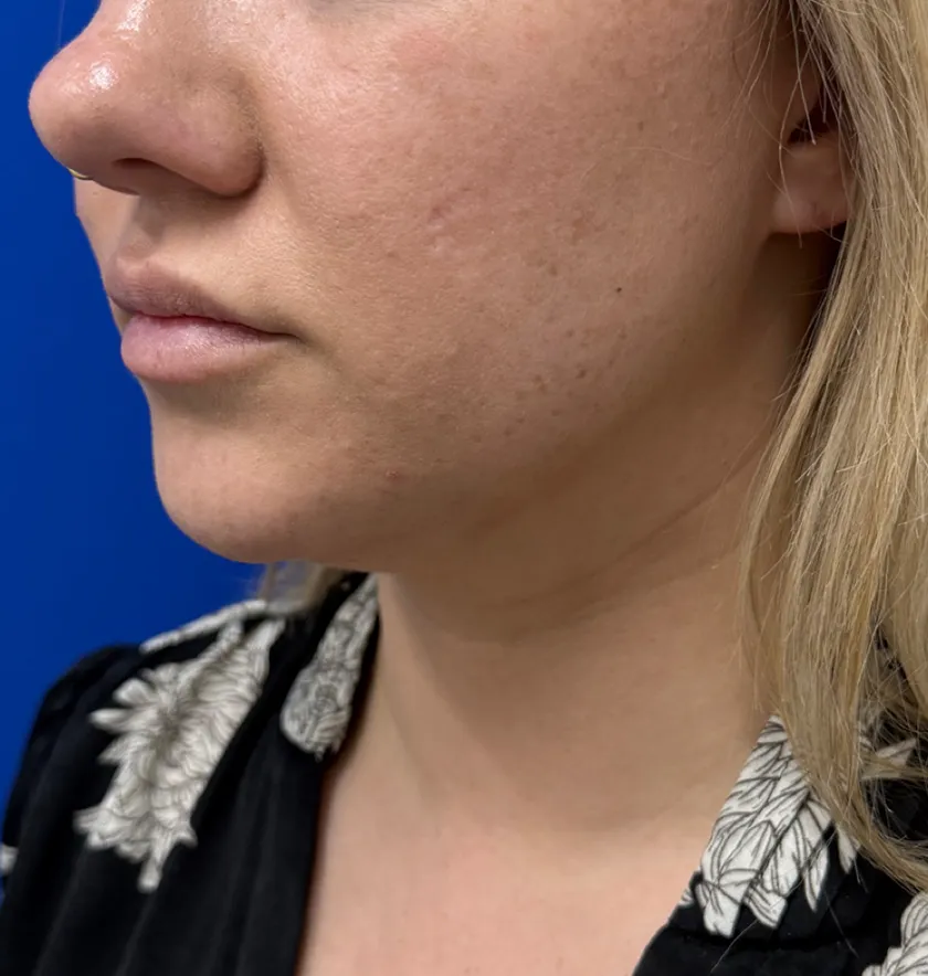 Neck Liposuction case #16426