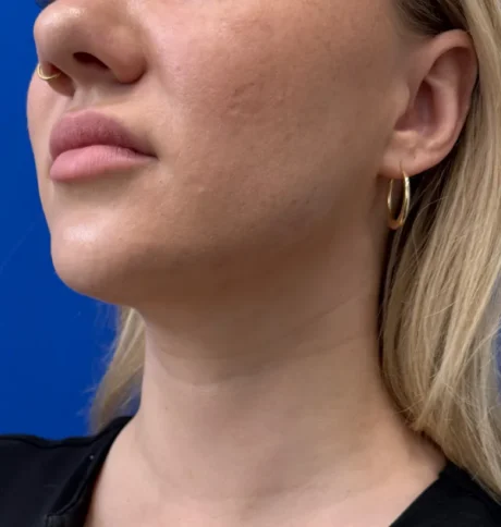 Neck Liposuction case #16426